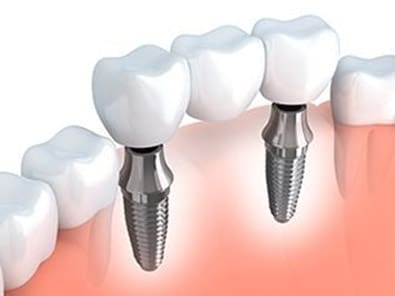 Implant-Supported Bridge