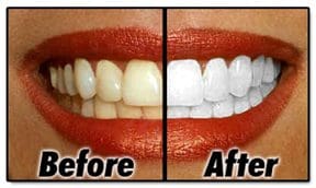 before after teeth whitening Kenosha