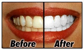 before after teeth whitening