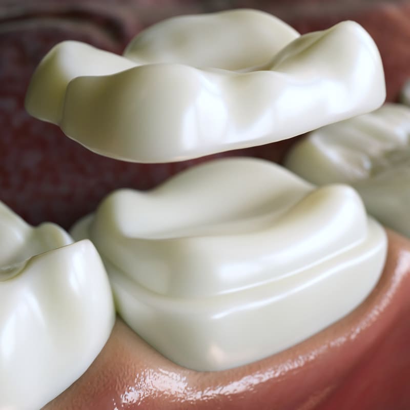 Dental technician applies ceramic material to the crown of a dental implant