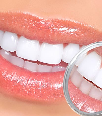 teeth whitening